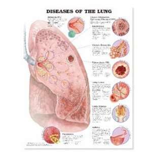 Diseases of the Lung Anatomical Chart Laminated:  
